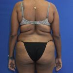 before tummy tuck back view female patient case 1893