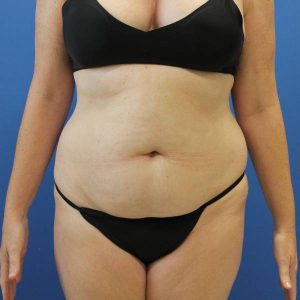 before tummy tuck right side view female patient case 1900