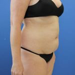 before tummy tuck right angle view female patient case 1900