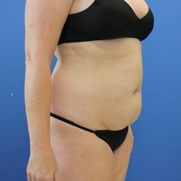 before tummy tuck right angle view female patient case 1900