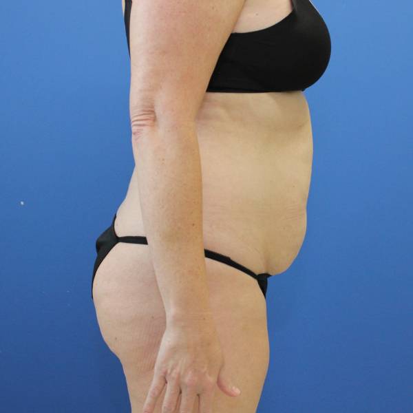 before tummy tuck right side view female patient case 1900