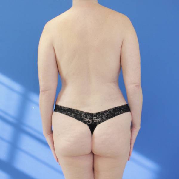 after tummy tuck back view female patient case 1900