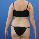before tummy tuck back view female patient case 1900
