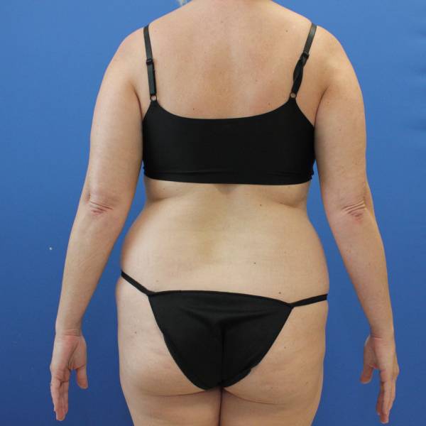 before tummy tuck back view female patient case 1900