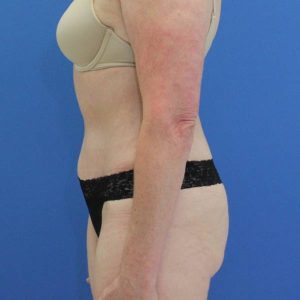 after tummy tuck left side view female patient case 1942