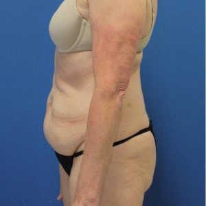 before tummy tuck left side view female patient case 1942