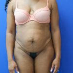 before tummy tuck front view female patient case 3395