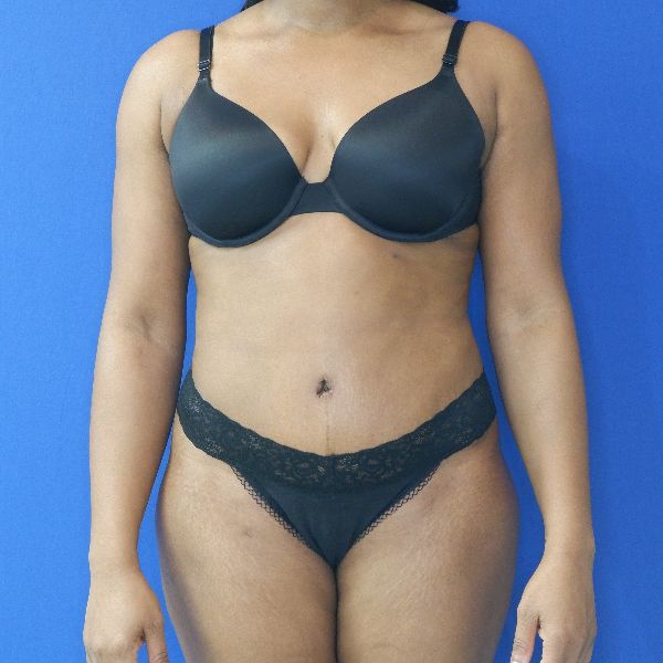 after tummy tuck front view female patient case 3395
