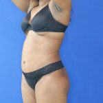 after tummy tuck left angle view female patient case 3395