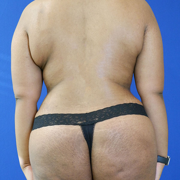 after tummy tuck back view female patient case 3408
