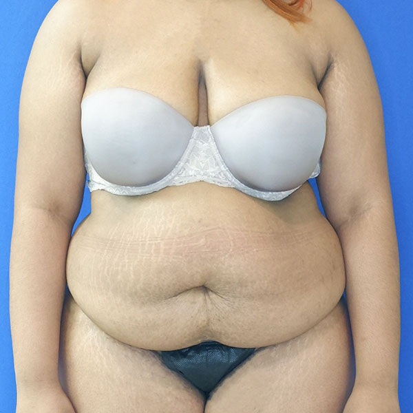 before tummy tuck front view female patient case 3408
