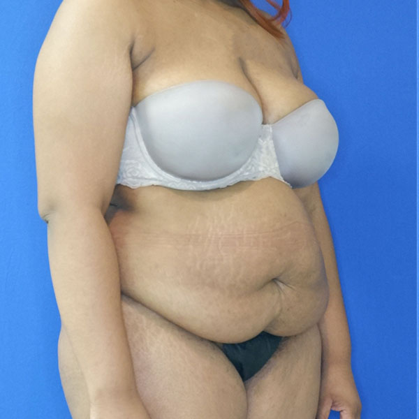 before tummy tuck right angle view female patient case 3408