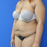 before tummy tuck left angle view female patient case 3408