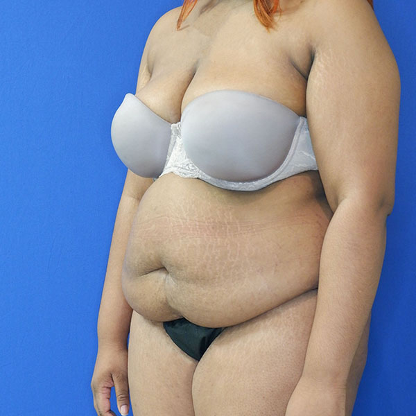 before tummy tuck left angle view female patient case 3408