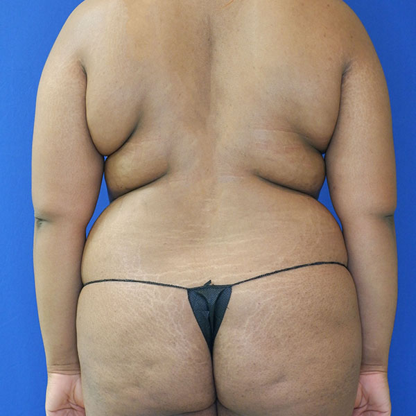 before tummy tuck back view female patient case 3408