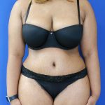 after tummy tuck front view female patient case 3408