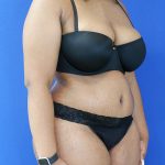 after tummy tuck right angle view female patient case 3408