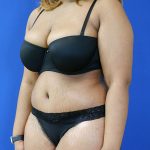 after tummy tuck left angle view female patient case 3408