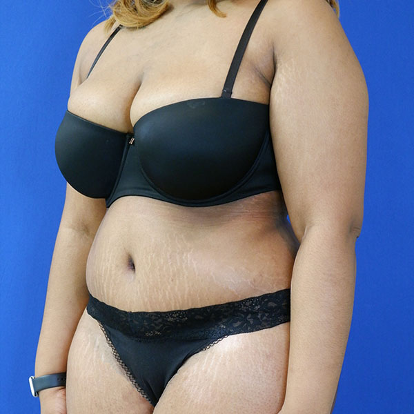 after tummy tuck left angle view female patient case 3408
