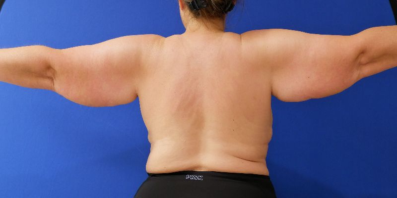 before arm lift back view arms out female patient case 3489