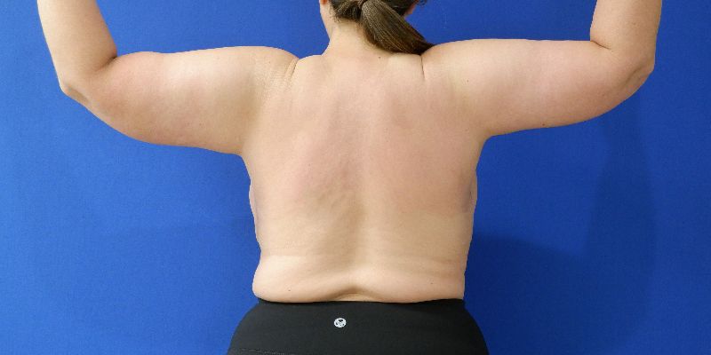 after arm lift back view arms up female patient case 3489