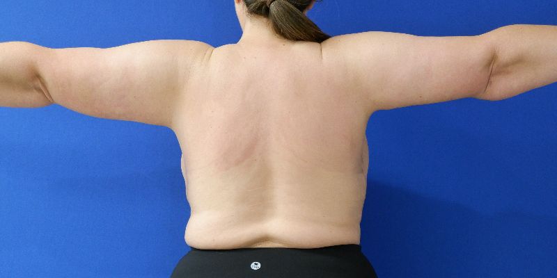 after arm lift back view arms out female patient case 3489