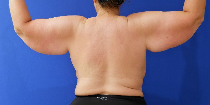 before arm lift back view arms up female patient case 3489