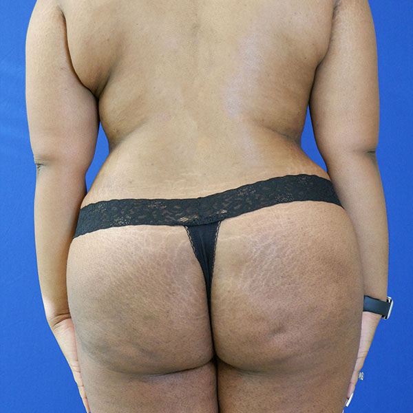 after brazillian butt lift back view female patient case 3468
