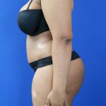after brazillian butt lift left view female patient case 3468