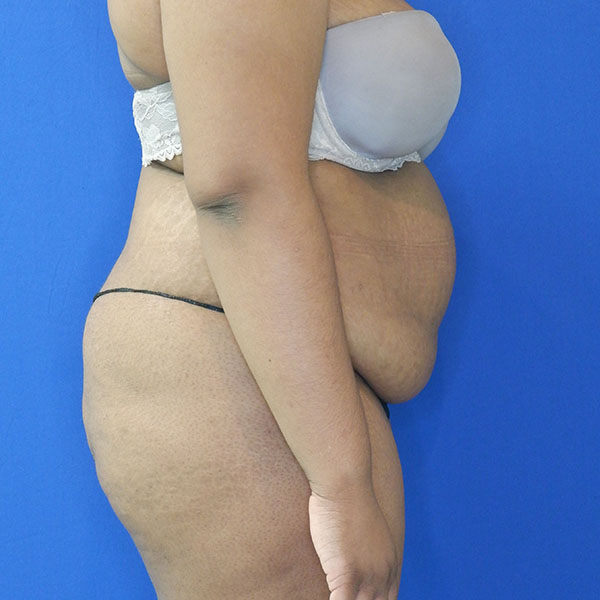 before brazillian butt lift right view female patient case 3468