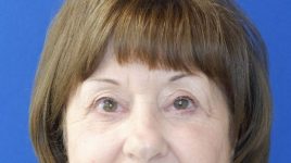 after blepharoplasty front view female patient case 3594