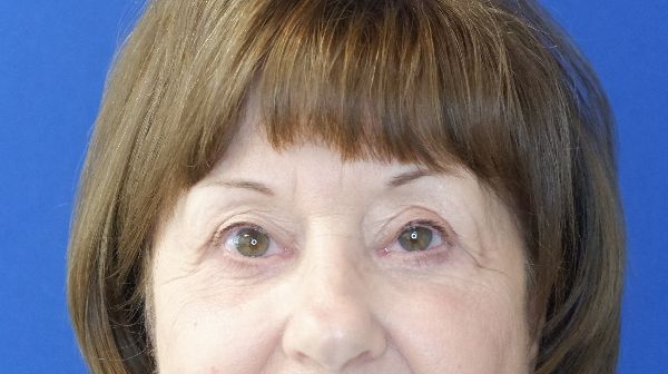 after blepharoplasty front view female patient case 3594