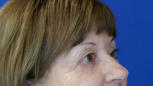 after blepharoplasty right angle view female patient case 3594