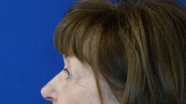 after blepharoplasty left view female patient case 3594