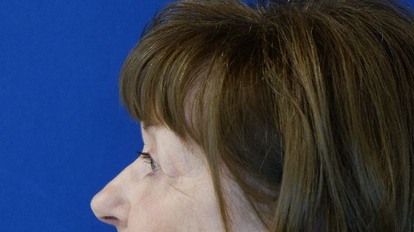 after blepharoplasty left view female patient case 3594