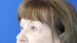 after blepharoplasty left angle view female patient case 3594