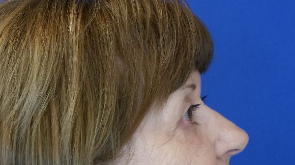 after blepharoplasty right view female patient case 3594
