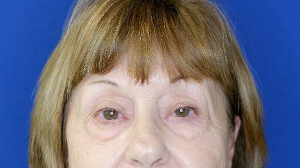 before blepharoplasty front view female patient case 3594