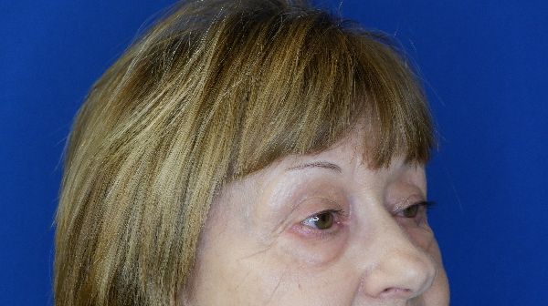 before blepharoplasty right angle view female patient case 3594