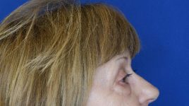 before blepharoplasty right view female patient case 3594
