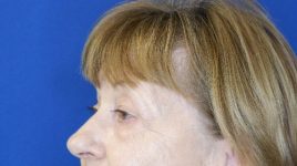 before blepharoplasty left angle view female patient case 3594
