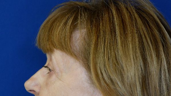 before blepharoplasty left view female patient case 3594