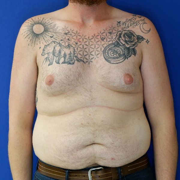 before gynecomastia front view male patient case 3695