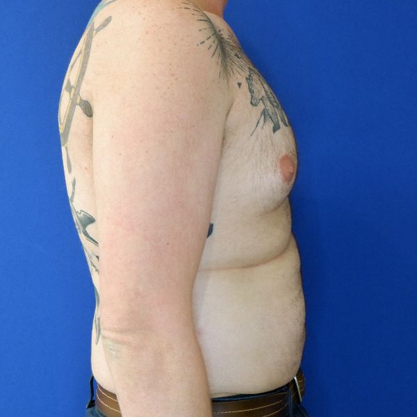 before gynecomastia right side view male patient case 3695