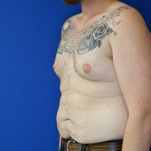 before gynecomastia left angle view male patient case 3695