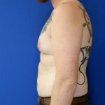 before gynecomastia left side view male patient case 3695