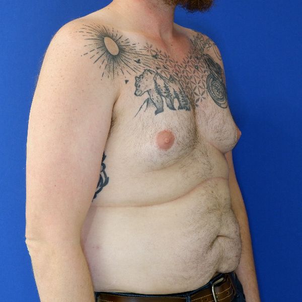 before gynecomastia left angle view male patient case 3695
