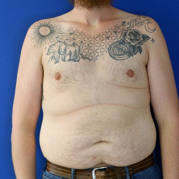 after gynecomastia front view male patient case 3695