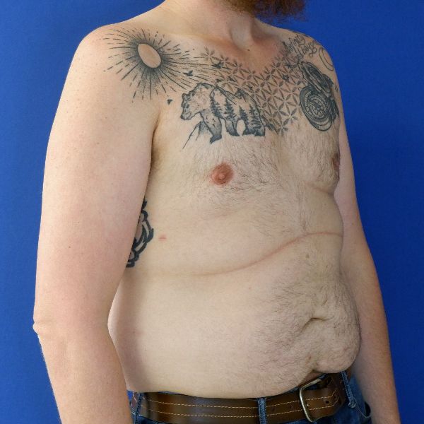 after gynecomastia right angle view male patient case 3695