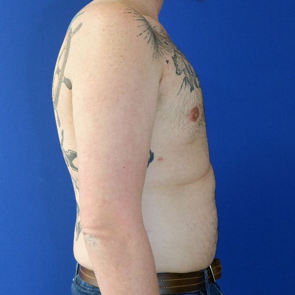 after gynecomastia right side view male patient case 3695